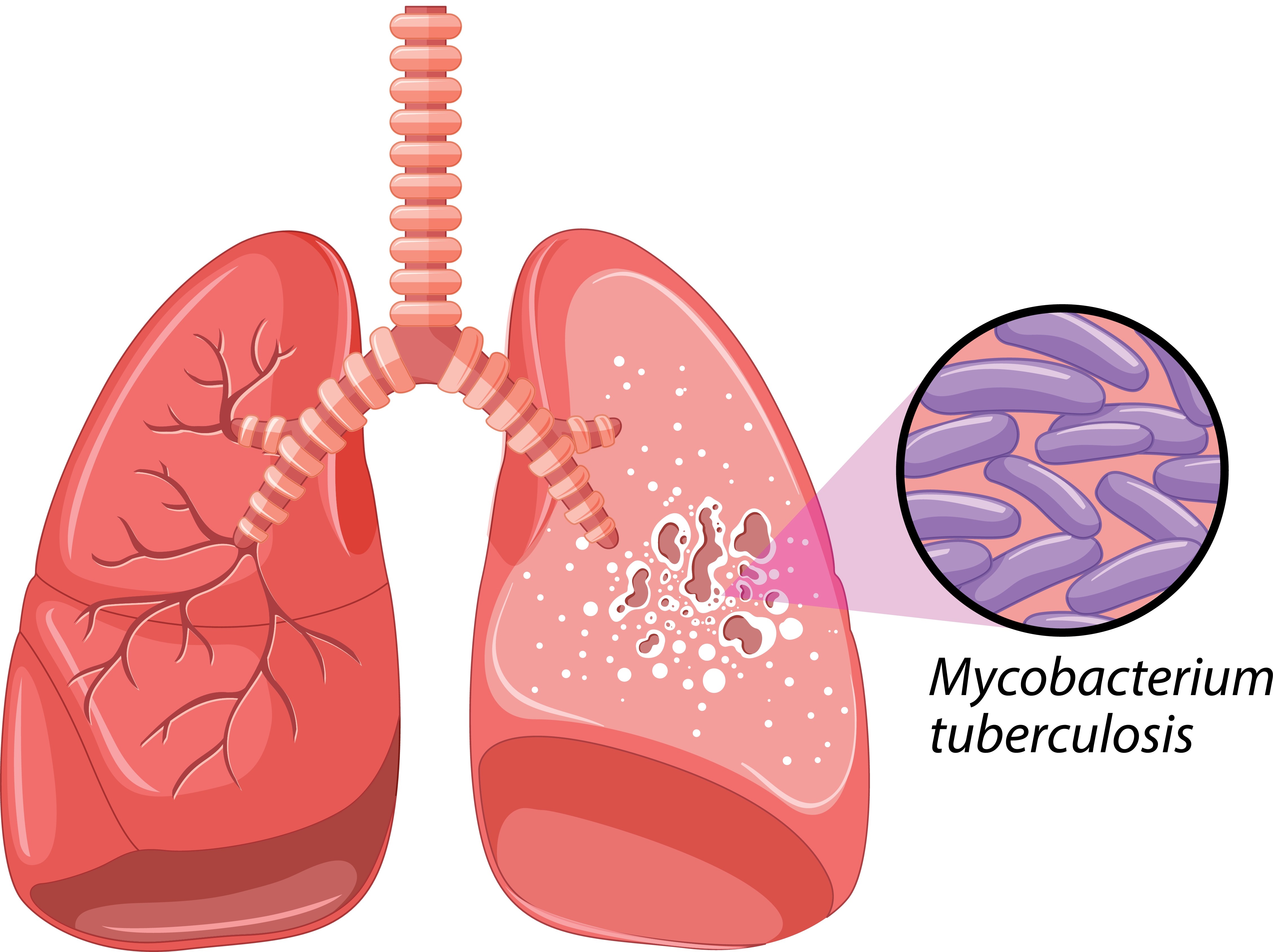 Tuberkulose 02